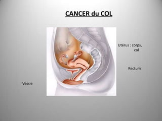 CANCER du COL



                         Utérus : corps,
                                   col



                               Rectum


Vessie
 