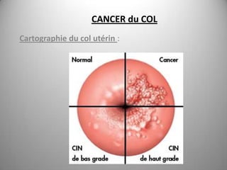 CANCER du COL
Cartographie du col utérin :
 