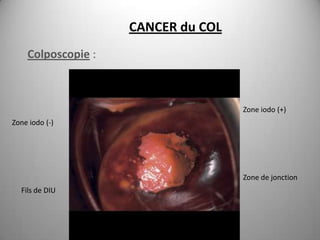 CANCER du COL
    Colposcopie :



                                    Zone iodo (+)
Zone iodo (-)




                                    Zone de jonction
  Fils de DIU
 