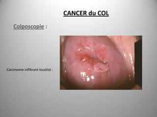 CANCER du COL
    Colposcopie :




Carcinome infiltrant localisé :
 