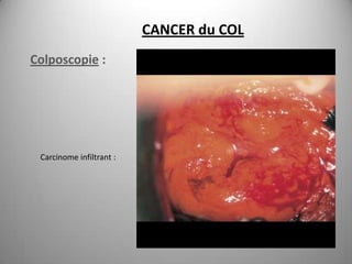 CANCER du COL
Colposcopie :




 Carcinome infiltrant :
 