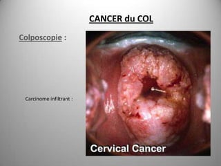 CANCER du COL
Colposcopie :




 Carcinome infiltrant :
 