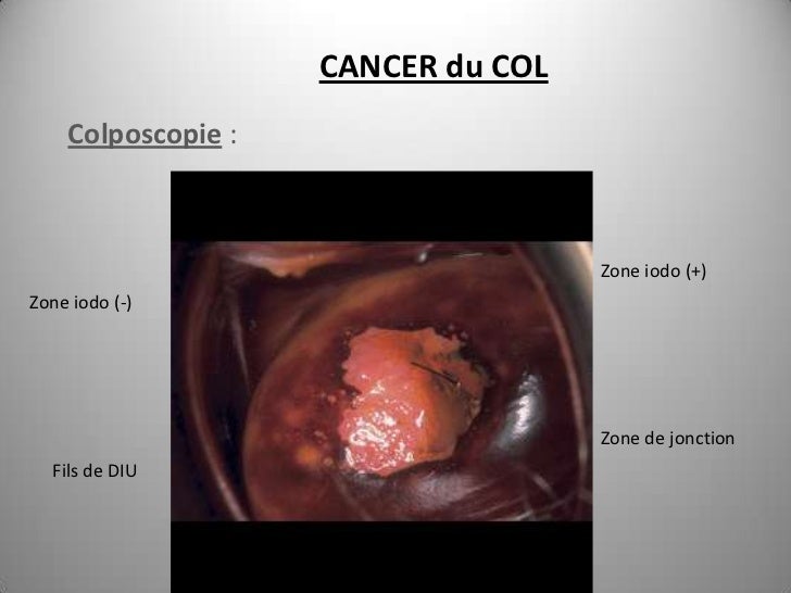 Cancer Du Col