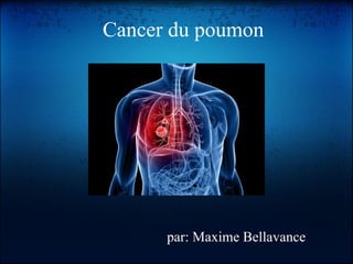 Cancer du poumon




      par: Maxime Bellavance
 