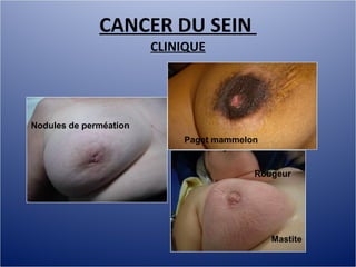 Cancer du sein 2010, mg