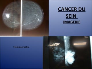 Cancer du sein 2010, mg