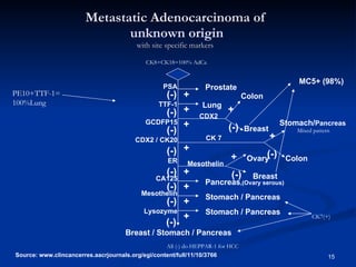 Metastatic Adenocarcinoma of   unknown origin with site specific markers PSA + (-) (-) (-) (-) (-) (-) (-) (-) + + + + + + + Prostate Lung Stomach/ Pancreas Breast Colon Colon Stomach / Pancreas Breast Ovary Pancreas ,(Ovary serous) Stomach / Pancreas Breast / Stomach / Pancreas  Source: www.clincancerres.aacrjournals.org/egi/content/full/11/10/3766 TTF-1 GCDFP15 CDX2 / CK20 ER CA125 Mesothelin Lysozyme + + + (-) (-) (-) CDX2 CK 7 Mesothelin MC5+ (98%) PE10+TTF-1=100%Lung CK8+CK18=100% AdCa CK7(+) All (-) do HEPPAR-1 for HCC Mixed pattern 
