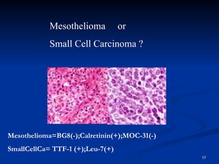 Mesothelioma  or  Small Cell Carcinoma ? Mesothelioma=BG8(-);Calretinin(+);MOC-31(-) SmallCellCa= TTF-1 (+);Leu-7(+) 