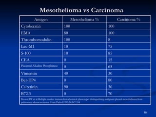 Mesothelioma vs Carcinoma Brown RW et al.Multiple-marker immunohistochemical phenotypes distinguishing malignant pleural mesothelioma from pulmonary adenocarcinoma. Hum Pathol.1993;24:347-354 70 0 B72.3 30 90 Calretinin 80 0 Ber-EP4 30 40 Vimentin 65 0 Placental Alkaline Phosphatase 15 0 CEA 85 10 S-100 75 10 Leu-M1 8 100 Thrombomodulin 100 80 EMA 100 100 Cytokeratin Carcinoma % Mesothelioma % Antigen 