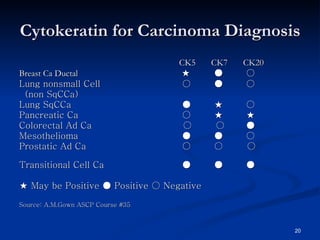 Cytokeratin for Carcinoma Diagnosis CK5 CK7 CK20 Breast Ca Ductal   ★  ●  ○ Lung nonsmall Cell      ○  ●   ○ (non SqCCa)    Lung SqCCa  ●   ★   ○ Pancreatic Ca     ○   ★   ★  Colorectal Ad Ca    ○  ○  ● Mesothelioma   ●   ●   ○ Prostatic Ad Ca  ○   ○  ○  Transitional Cell Ca  ●   ●   ●  ★  May be Positive ● Positive ○ Negative Source: A.M.Gown ASCP Course #35 