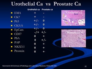 Urothelial Ca  vs  Prostate Ca EMA CK7 P63 CK5/6 EpCam CD57 PSA PAP NKX3.1 Prostein + - + - +/- 0 +/- 0 +/- 0 -/+ +/- 0 + 0 +/- 0 + 0 + 0 + Urothelial ca Prostate ca Hammerich KH.Archives of Pathology and Laboratory Medicine;132(3):432-440 Urothelial ca Prostate ca 