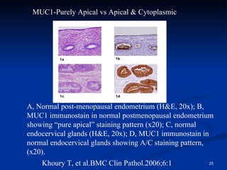 A, Normal post-menopausal endometrium (H&E, 20x); B, MUC1 immunostain in normal postmenopausal endometrium showing “pure apical” staining pattern (x20); C, normal endocervical glands (H&E, 20x); D, MUC1 immunostain in normal endocervical glands showing A/C staining pattern, (x20).  MUC1-Purely Apical vs Apical & Cytoplasmic Khoury T, et al.BMC Clin Pathol.2006;6:1 