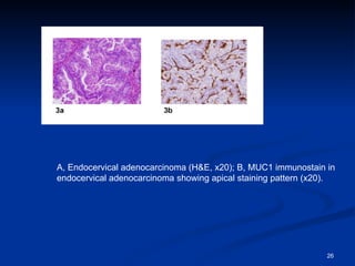 A, Endocervical adenocarcinoma (H&E, x20); B, MUC1 immunostain in endocervical adenocarcinoma showing apical staining pattern (x20).  