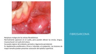 FIBROSARCOMA
Neoplasia maligna de las células fibroblásticas.
Normalmente aparecen en el cuello, pero pueden afectar las encías, lengua,
mucosa bucal o el suelo de la boca.
Se puede originar del endostio, periostio o ligamento periodontal.
Es rápidamente proliferante y firme e indurado a la palpación. Las lesiones de
mayor tamaño pueden presentar ulceración del epitelio superficial.
 
