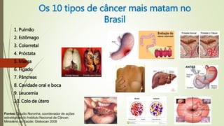 Os 10 tipos de câncer mais matam no
Brasil
1. Pulmão
2. Estômago
3. Colorretal
4. Próstata
5. Mama
6. Fígado
7. Pâncreas
8. Cavidade oral e boca
9. Leucemia
10. Colo de útero
Fontes Cláudio Noronha, coordenador de ações
estratégicas do Instituto Nacional de Câncer;
Ministério da Saúde; Globocan 2008
 