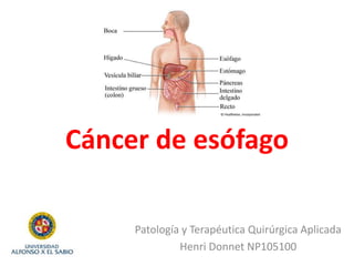 Cáncer de esófago
Patología y Terapéutica Quirúrgica Aplicada
Henri Donnet NP105100
 