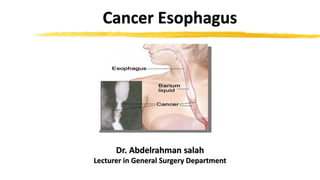 Dr. Abdelrahman salah
Lecturer in General Surgery Department
Cancer Esophagus
 