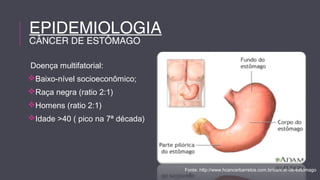 Doença multifatorial: 
Baixo-nível socioeconômico; 
Raça negra (ratio 2:1) 
Homens (ratio 2:1) 
Idade >40 ( pico na 7ª década) 
Fonte: http://www.hcancerbarretos.com.br/cancer-de-estomago 
EPIDEMIOLOGIA 
CÂNCER DE ESTÔMAGO 
 