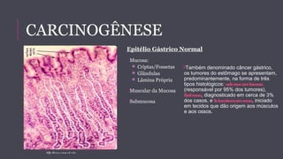 CARCINOGÊNESE 
Epitélio Gástrico Normal 
Mucosa: 
 Criptas/Fossetas 
 Glândulas 
 Lâmina Própria 
Muscular da Mucosa 
Submucosa 
http : //www. s ium e d . e du 
Também denominado câncer gástrico, 
os tumores do estômago se apresentam, 
predominantemente, na forma de três 
tipos histológicos: adenocarcinoma 
(responsável por 95% dos tumores), 
linfoma, diagnosticado em cerca de 3% 
dos casos, e leiomiossarcoma, iniciado 
em tecidos que dão origem aos músculos 
e aos ossos. 
 