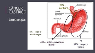CÂNCER 
GÁSTRICO 
Localização 
 