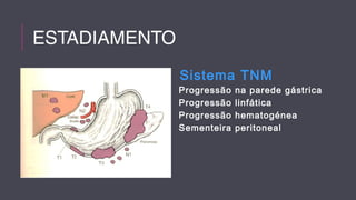 ESTADIAMENTO 
Sistema TNM 
Progressão na parede gástrica 
Progressão linfática 
Progressão hematogénea 
Sementeira peritoneal 
 