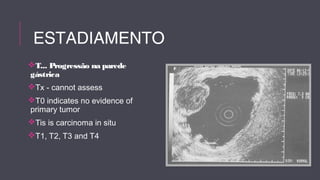 ESTADIAMENTO 
T... Progressão na parede 
gástrica 
Tx - cannot assess 
T0 indicates no evidence of 
primary tumor 
Tis is carcinoma in situ 
T1, T2, T3 and T4 
 