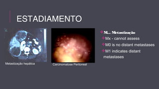 Metastização hepática Carcinomatose Peritoneal 
M... Metastização 
Mx - cannot assess 
M0 is no distant metastases 
M1 indicates distant 
metastases 
ESTADIAMENTO 
 