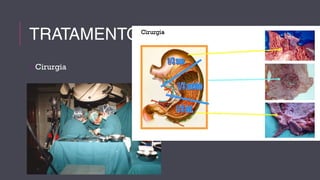 TRATAMENTO 
Cirurgia 
 
