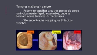 Tumores malignos – cancro 
- Podem-se espalhar a outras partes do corpo 
(principalmente fígado e pulmão), onde se 
formam novos tumores  metástases 
- São encontradas nos gânglios linfáticos 
vizinhos 
 