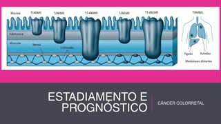 ESTADIAMENTO E 
PROGNÓSTICO CÂNCER COLORRETAL 
 