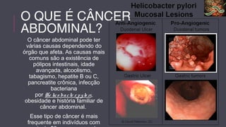 O QUE É CÂNCER 
ABDOMINAL? 
O câncer abdominal pode ter 
várias causas dependendo do 
órgão que afeta. As causas mais 
comuns são a existência de 
pólipos intestinais, idade 
avançada, alcoolismo, 
tabagismo, hepatite B ou C, 
pancreatite crônica, infecção 
bacteriana 
por He lic o ba c te r p y lo ri, 
obesidade e história familiar de 
câncer abdominal. 
Esse tipo de câncer é mais 
frequente em indivíduos com 
mais de 50 anos, mas pode 
 