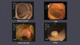 Mucosa normal Cego 
Cancro do cólon 
Pólipo 
 