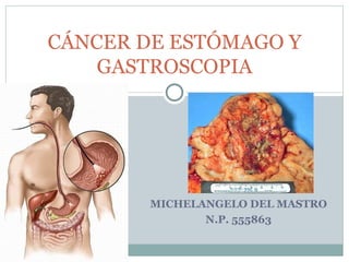 CÁNCER DE ESTÓMAGO Y
    GASTROSCOPIA




        MICHELANGELO DEL MASTRO
               N.P. 555863
 