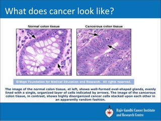 The image of the normal colon tissue, at left, shows well-formed oval-shaped glands, evenly
lined with a single, organized layer of cells indicated by arrows. The image of the cancerous
colon tissue, in contrast, shows highly disorganized cancer cells stacked upon each other in
an apparently random fashion.
What does cancer look like?
 