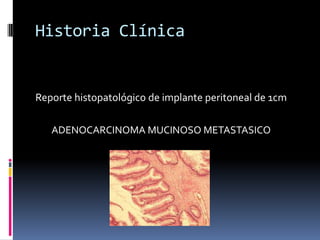 Historia ClínicaReporte histopatológico de implante peritoneal de 1cmADENOCARCINOMA MUCINOSO METASTASICO