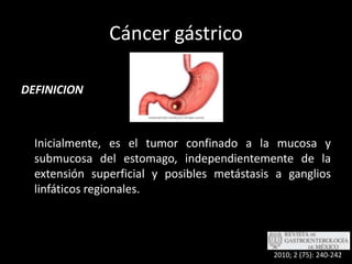 Cáncer gástricoDEFINICION	Inicialmente, es el tumor confinado a la mucosa y submucosa del estomago, independientemente de la extensión superficial y posibles metástasis a ganglios linfáticos regionales.2010; 2 (75): 240-242