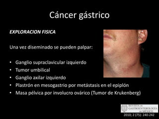 Cáncer gástricoEXPLORACION FISICAUna vez diseminado se pueden palpar:Ganglio supraclavicular izquierdoTumor umbilicalGanglio axilar izquierdoPlastrón en mesogastrio por metástasis en el epiplónMasa pélvica por involucro ovárico (Tumor de Krukenberg)2010; 2 (75): 240-242