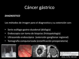 Cáncer gástricoDIAGNOSTICOLos métodos de imagen para el diagnostico y su extensión son:Serie esófago-gastro-duodenal (disfagia)Endoscopia con toma de biopsias (histopatología)Ultrasonido endoscópico  (extensión ganglionar regional)Tomografía computarizada (estatificación preoperatoria)2010; 2 (75): 240-242