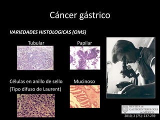 Cáncer gástricoVARIEDADES HISTOLOGICAS (OMS)		  Tubular		   PapilarCélulas en anillo de sello	Mucinoso(Tipo difuso de Laurent)2010; 2 (75): 237-239
