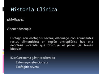 Historia Clínica1/MAR/2011Videoendoscopía	Esófago con esofagitis severa; estomago con abundantes restos alimenticios; en región antropilórica hay una neoplasia ulcerada que obstruye el píloro (se toman biopsias).	IDx: Carcinoma gástrico ulcerado		Estomago retencionista		Esofagitis severa