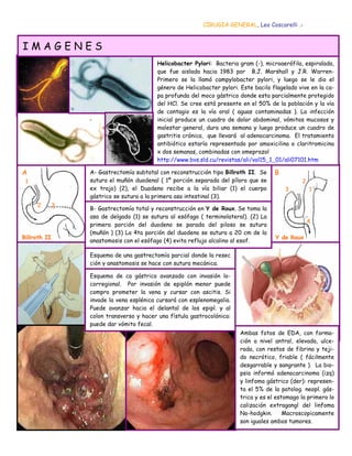 CIRUGIA GENERAL, Leo Coscarelli .-


IMAGENES
                                          Helicobacter Pylori: Bacteria gram (-), microaerófila, espiralada,
                                          que fue aislada hacia 1983 por B.J. Marshall y J.R. Warren-
                                          Primero se la llamó campylobacter pylori, y luego se le dio el
                                          género de Helicobacter pylori. Este bacilo flagelado vive en la ca-
                                          pa profunda del moco gástrico donde esta parcialmente protegido
                                          del HCl. Se cree está presente en el 50% de la población y la vía
                                          de contagio es la vía oral ( aguas contaminadas ). La infección
                                          inicial produce un cuadro de dolor abdominal, vómitos mucosos y
                                          malestar general, dura una semana y luego produce un cuadro de
                                          gastritis crónica, que llevará al adenocarcinoma. El tratamiento
                                          antibiótico estaría representado por amoxicilina o claritromicina
                                          x dos semanas, combinadas con omeprazol
                                          http://www.bvs.sld.cu/revistas/ali/vol15_1_01/ali07101.htm

A                 A- Gastrectomía subtotal con reconstrucción tipo Billroth II. Se    B
 1                sutura el muñón duodenal ( 1º porción separada del píloro que se              2
                  ex trajo) (2), el Duodeno recibe a la vía biliar (1) el cuerpo          3         1
                  gástrico se sutura a la primera asa intestinal (3).
     2        3
                  B- Gastrectomía total y reconstrucción en Y de Roux. Se toma la
                  asa de delgado (1) se sutura al esófago ( terminolateral). (2) La
                                                                                                    4
                  primera porción del duodeno se parada del piloso se sutura
                  (muñón ) (3) La 4ta porción del duodeno se sutura a 20 cm de la
Billroth II                                                                           Y de Roux
                  anastomosis con el esófago (4) evita reflujo alcalino al esof.

                  Esquema de una gastrectomía parcial donde la resec
                  ción y anastomosis se hace con sutura mecánica.

                  Esquema de ca gástrico avanzado con invasión lo-
                  corregional. Por invasión de epiplón menor puede
                  compro prometer la vena y cursar con ascitis. Si
                  invade la vena esplénica cursará con esplenomegalia.
                  Puede avanzar hacia el delantal de los epipl. y al
                  colon transverso y hacer una fístula gastrocolónica:
                  puede dar vómito fecal.
                                                                         Ambas fotos de EDA, con forma-
                                                                         ción a nivel antral, elevada, ulce-
                                                                         rada, con restos de fibrina y teji-
                                                                         do necrótico, friable ( fácilmente
                                                                         desgarrable y sangrante ). La bio-
                                                                         psia informó adenocarcinoma (izq)
                                                                         y linfoma gástrico (der): represen-
                                                                         ta el 5% de la patolog. neopl. gás-
                                                                         trica y es el estomago la primera lo
                                                                         calización extragangl del linfoma
                                                                         No-hodgkin.      Macroscopicamente
                                                                         son iguales ambos tumores.
 