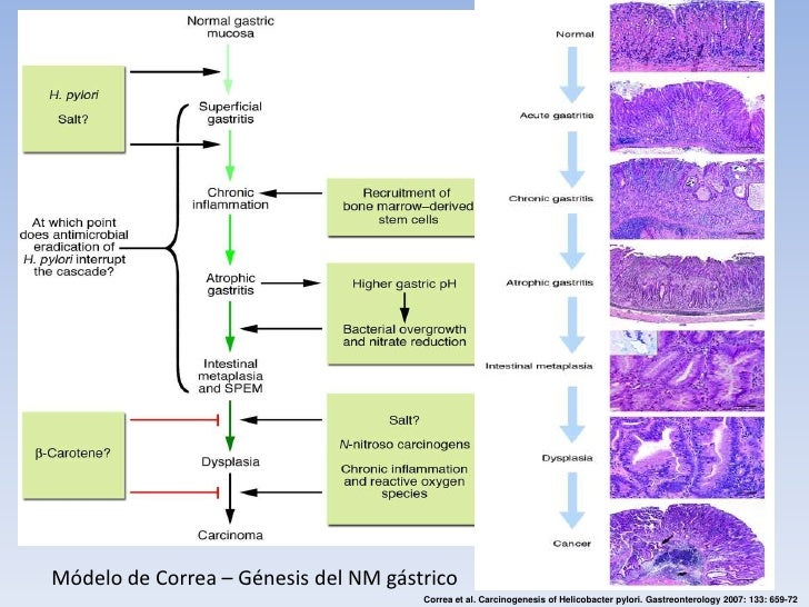 Cancer gastrico