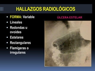 HALLAZGOS RADIOLÓGICOS
 FORMA: Variable    ÚLCERA ESTELAR
 Lineales
 Redondas u
  ovoides
 Estelares
 Rectangulares
...