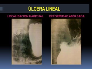 ÚLCERA LINEAL
LOCALIZACIÓN HABITUAL   DEFORMIDAD ABOLSADA
 