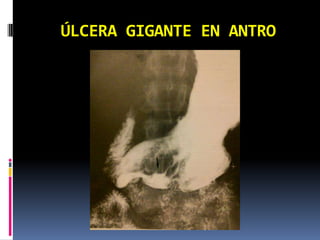 ÚLCERA GIGANTE EN ANTRO
 