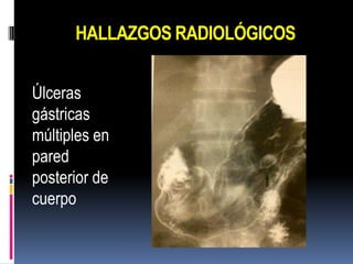 HALLAZGOS RADIOLÓGICOS


Úlceras
gástricas
múltiples en
pared
posterior de
cuerpo
 