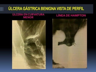 ÚLCERA GÁSTRICA BENIGNA VISTA DE PERFIL
  ÚLCERA EN CURVATURA   LÍNEA DE HAMPTON
        MENOR
 
