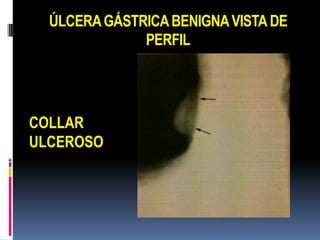 ÚLCERA GÁSTRICA BENIGNA VISTA DE
              PERFIL




COLLAR
ULCEROSO
 
