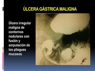 ÚLCERA GÁSTRICA MALIGNA

Úlcera irregular
maligna de
contornos
nodulares con
fusión y
amputación de
los pliegues
mucosos.
 