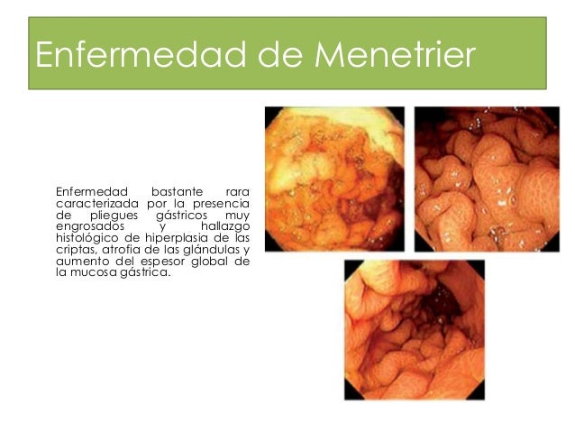 Enfermedad De Menetrier Pdf